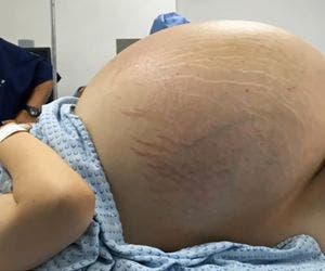 Médicos retiram de ovário cisto com peso de 10 bebês no México