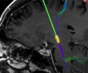 Estimulação cerebral profunda freia tremores do mal de Parkinson