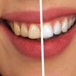Lente contato dental: saiba quais são os riscos do procedimento