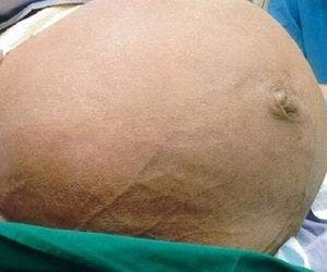 Mioma uterino de 64 centímetros e 28 kg é removido de paciente