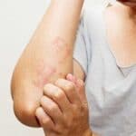 Dermatite atópica não tem cura, mas pode ser controlada em casa