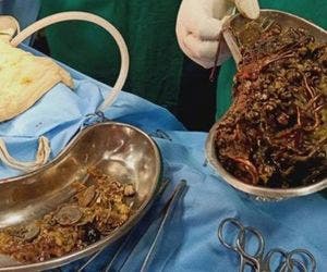 Médicos retiram R$250 mil em joias do estômago de paciente