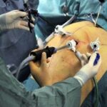 Qual é o risco de complicações após a cirurgia bariátrica?