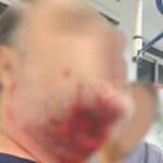 Paciente surta e arranca pedaço de rosto de médico com mordida