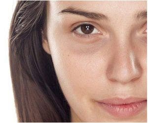 Veja mitos e verdades sobre tratamento de olheiras