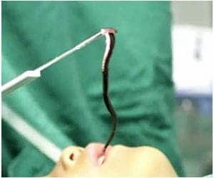 Sanguessuga gigante é removido de cabeça de menino após um ano