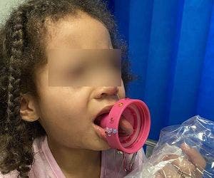 Criança passa por cirurgia após ficar com a língua presa