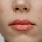 Pump lips: conheça procedimento estético para lábios volumosos