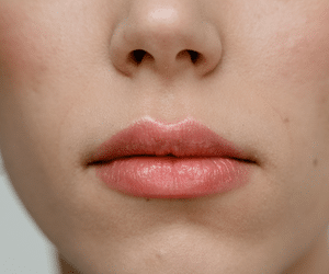 Pump lips: conheça procedimento estético para lábios volumosos
