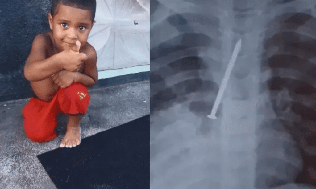 Garoto de 3 anos morre com prego no pulmão no sul da Bahia