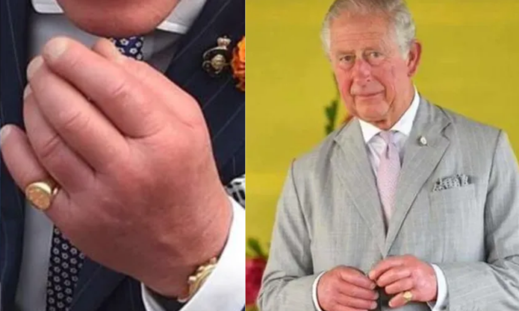 ‘Dedos de salsicha’: saiba o que pode causar e os riscos do inchaço nas mãos do rei Charles III