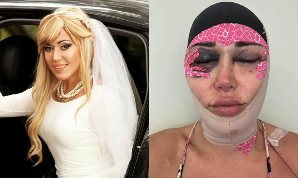 Mulher Abacaxi choca ao aparecer completamente desfigurada após cirurgia