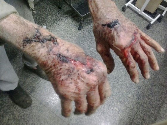 Homem de 91 anos foi agredido e ficou com marcas nas mãos em Gravataí (Foto: Divulgação/BM)